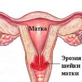 Воспаление шейки матки, причины, диагностика и лечение | МЦ Докторплюс, Сургут